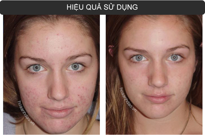 Bộ sản phẩm kem giúp giảm mụn MD Complexion Factor hiệu quả
