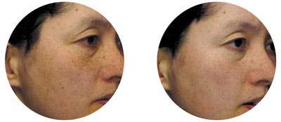 Niacinamide làm trắng da an toàn