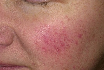 Điều trị Rosacea, mụn trứng cá đỏ khi mang thai