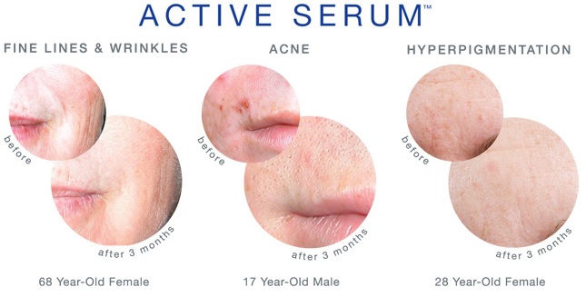serum-dieu-tri-mun-cam-dau-den-is-clinical-active-serum
