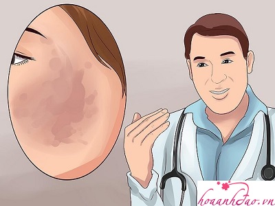 Đi tìm nguyên nhân gây nám da