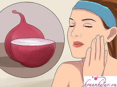 Dùng hành tím để trị hết nám da mặt