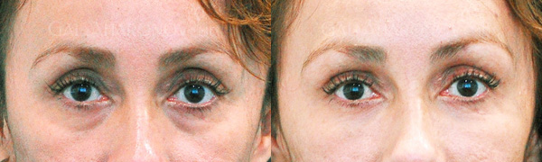 kem-duong-da-xoa-tham-quang-mat-neova-eye-therapy