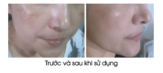 Trước và sau khi sử dụng Kem trị nám ban đêm Sakura Spots Care & Whitening Night Cream